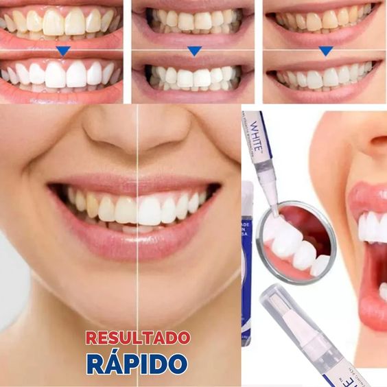 LAPIZ BLANQUEADOR DENTAL